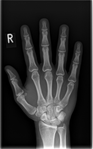 Röntgen rechte Hand