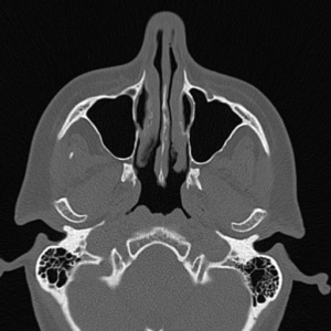 CT der Nasennebenhöhlen